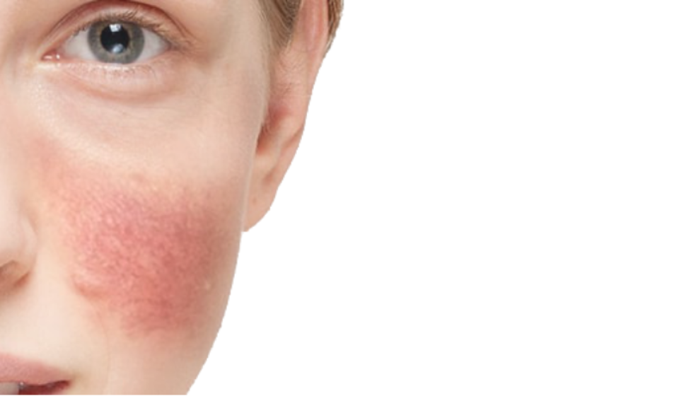 rosacea-e-oleos-essenciais